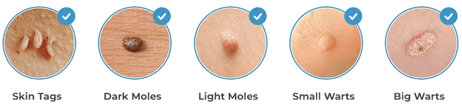 amarose skin tag remover work removal